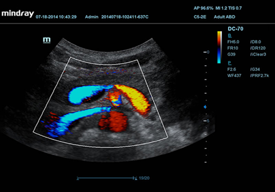2D Pancreas & Vascular Flow