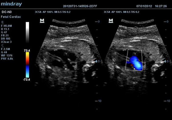 Fetal Left Vetricular Outflow Tract