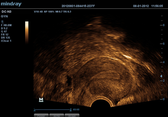 Uterus with TV probe