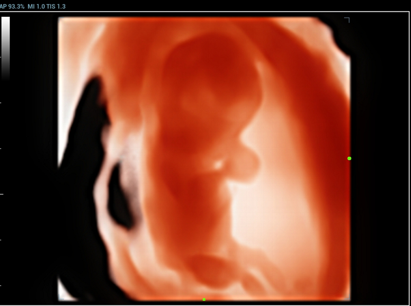 fetal 3d ilive